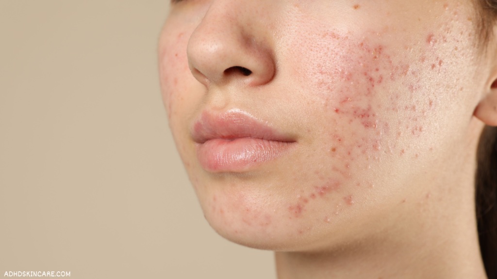 An image showing a woman with oily skin and acne