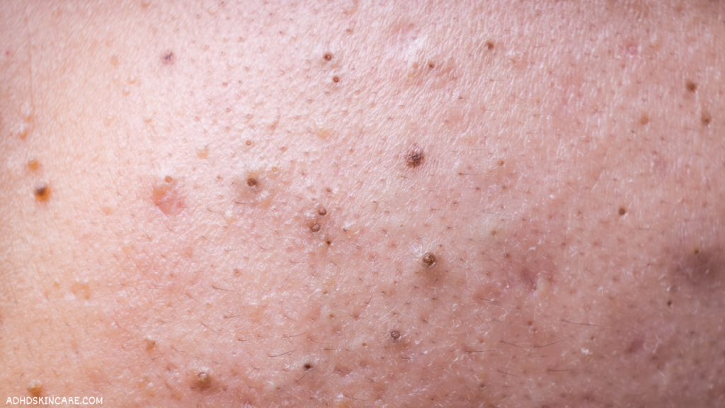 an image showing oily skin with blackheads