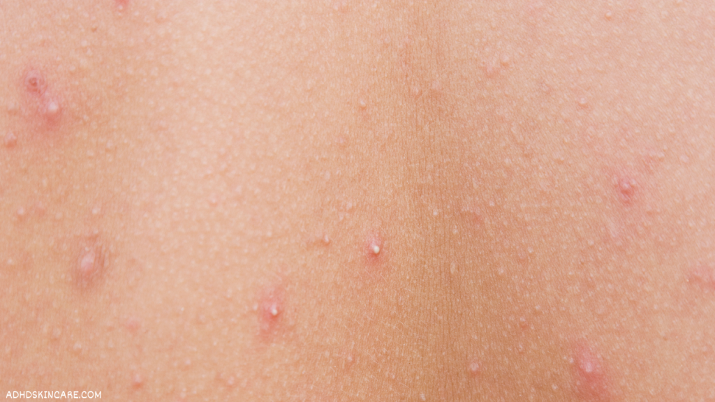 whiteheads also known as closed comedones