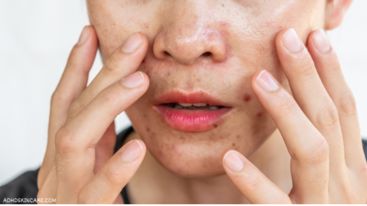 a woman with oily skin who needs a 4-step skincare routine for oily skin