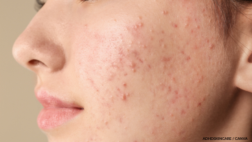Profile view of acne on the cheek Adderall skincare routine concerns.