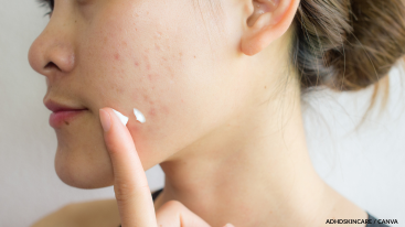 Side view of a woman with acne touching her cheek, representing acne management in an Adderall skincare routine.