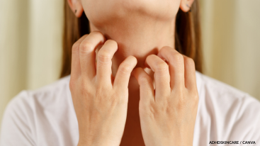 Woman scratching her neck, highlighting allergic reactions that may occur in an Adderall skincare routine.