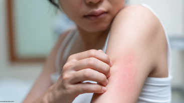 Woman scratching red, irritated skin on her arm used to show how Ritalin affects skin through sensitivity and dryness.