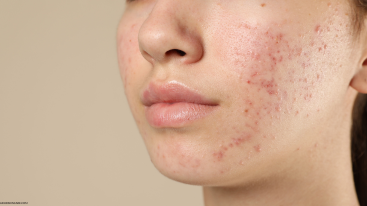 Acne and redness on cheek illustrating how Ritalin affects skin by contributing to breakouts or inflammation