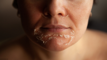 A woman with flaky skin caused by ADHD medication like Ritalin