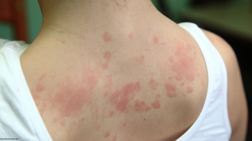 A woman having allergic reactions caused by ADHD medication like Ritalin